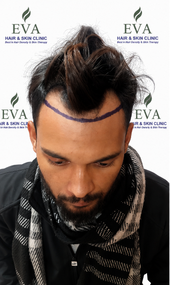 Before hair transplant result 5
